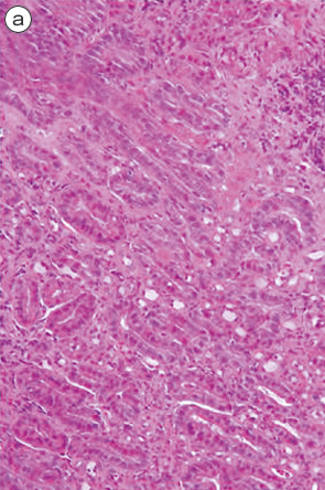 安易なGroup 2，indefinite for neoplasia，再生検は避けるべきである a