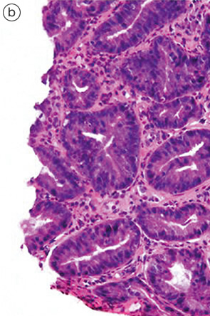 安易なGroup 2，indefinite for neoplasia，再生検は避けるべきである b