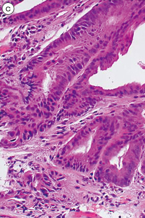 安易なGroup 2，indefinite for neoplasia，再生検は避けるべきである c