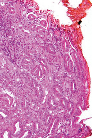 安易なGroup 2，indefinite for neoplasia，再生検は避けるべきである a