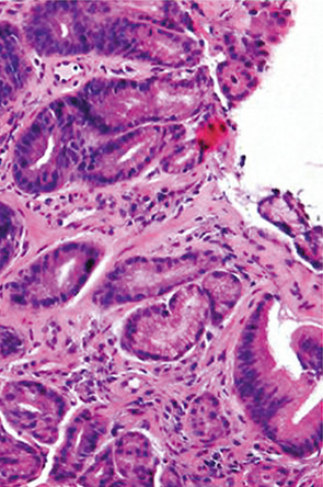 安易なGroup 2，indefinite for neoplasia，再生検は避けるべきである b