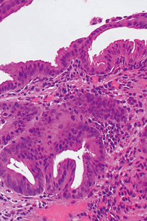 安易なGroup 2，indefinite for neoplasia，再生検は避けるべきである c