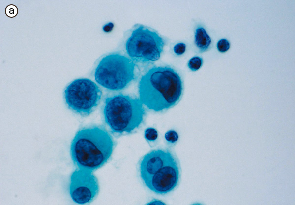 腹水中の腺癌（パパニコロウ染色）。偏在した核が特徴である。