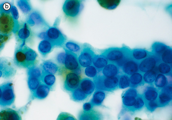 参考症例（原発性肺癌）。症例と同倍率である（対物×20）。細胞はより小型で背が低い。核も類円形～卵円系である。