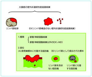 図1　壁外非連続性進展病巣の分類