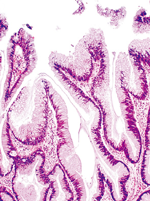 adenomatous type neoplasia