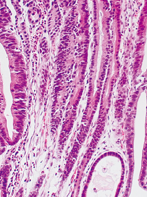 basal cell type neoplasia