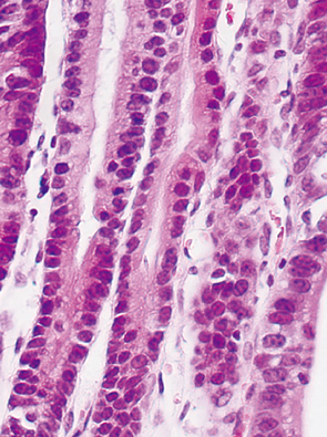 basal cell type neoplasia