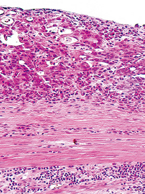 in-situ anaplasia