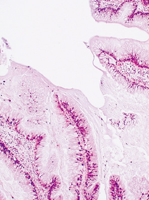 clear cell type neoplasia