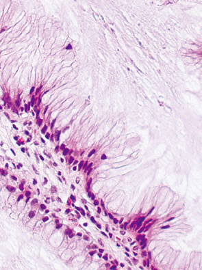 clear cell type neoplasia