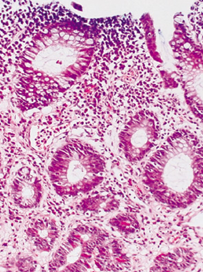 pancellular type neoplasia