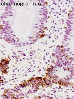 pancellular type neoplasia