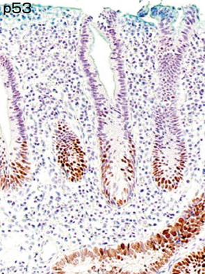 粘膜筋板に並行する不規則腺管を認める病変