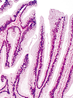 adenomatous type neoplasia