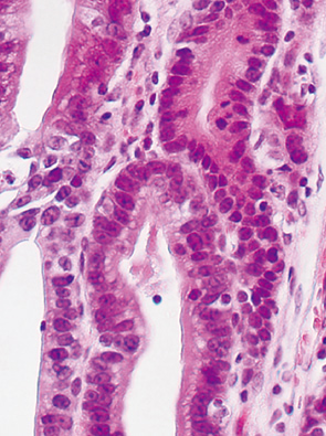 basal cell type neoplasia