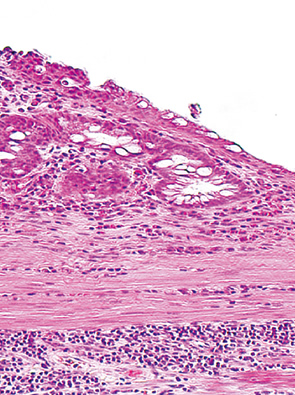 in-situ anaplasia