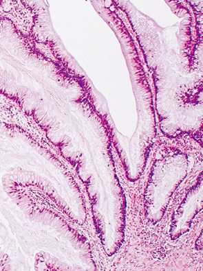 clear cell type neoplasia