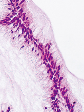 clear cell type neoplasia