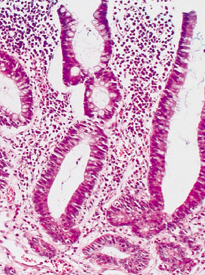 pancellular type neoplasia