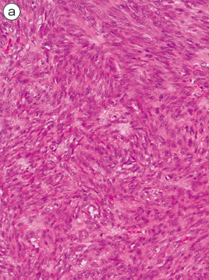 胃腸管間質腫瘍（gastrointestinal stromal tumor：GIST）