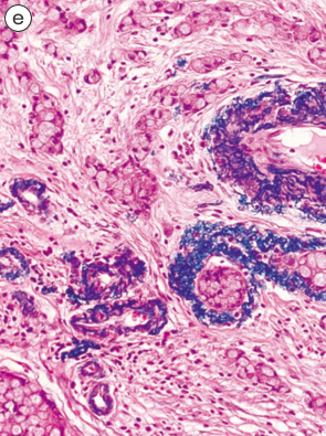 杯細胞カルチノイド（goblet cell carcinoid）