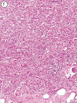 杯細胞カルチノイド（goblet cell carcinoid）