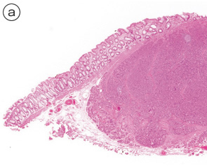 カルチノイド（carcinoid tumor）