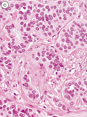 カルチノイド（carcinoid tumor）