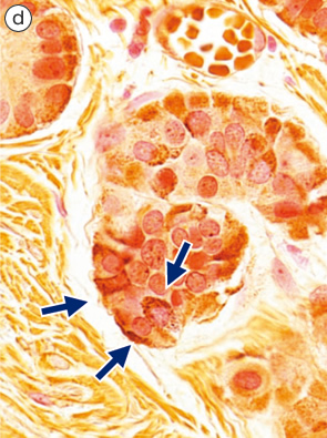 カルチノイド（carcinoid tumor）