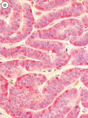 カルチノイド（carcinoid tumor）