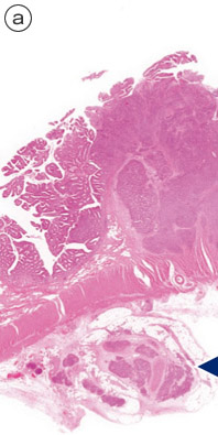 内分泌細胞癌（endocrine cell carcinoma）