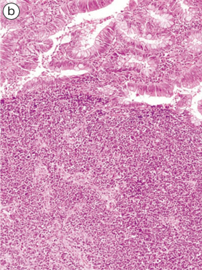 内分泌細胞癌（endocrine cell carcinoma）