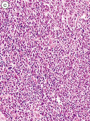 内分泌細胞癌（endocrine cell carcinoma）