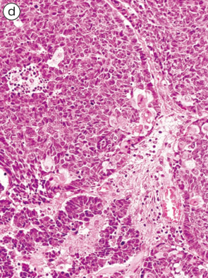 内分泌細胞癌（endocrine cell carcinoma）