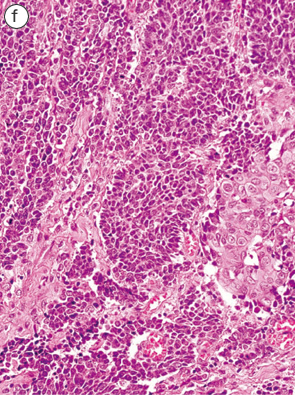 内分泌細胞癌（endocrine cell carcinoma）