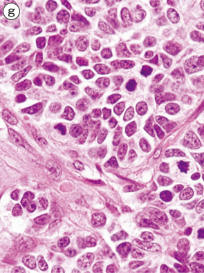 内分泌細胞癌（endocrine cell carcinoma）