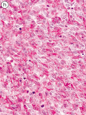 内分泌細胞癌（endocrine cell carcinoma）