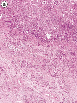 杯細胞カルチノイド（goblet cell carcinoid）