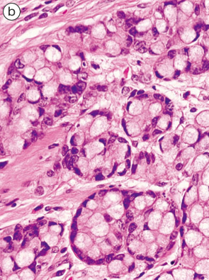 杯細胞カルチノイド（goblet cell carcinoid）