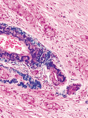 杯細胞カルチノイド（goblet cell carcinoid）