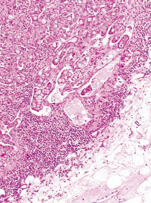 杯細胞カルチノイド（goblet cell carcinoid）