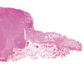 カルチノイド（carcinoid tumor）