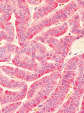 カルチノイド（carcinoid tumor）