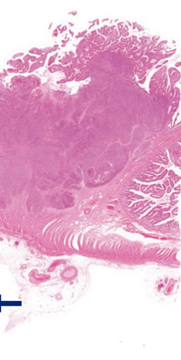 内分泌細胞癌（endocrine cell carcinoma）