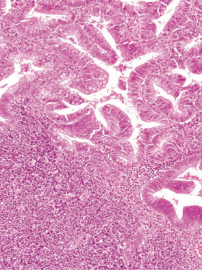 内分泌細胞癌（endocrine cell carcinoma）