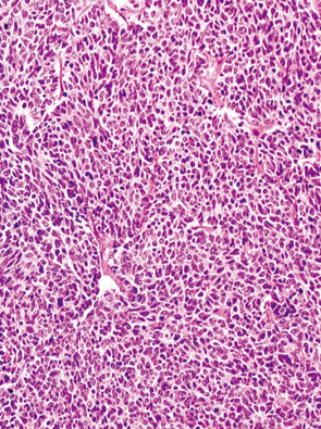 内分泌細胞癌（endocrine cell carcinoma）