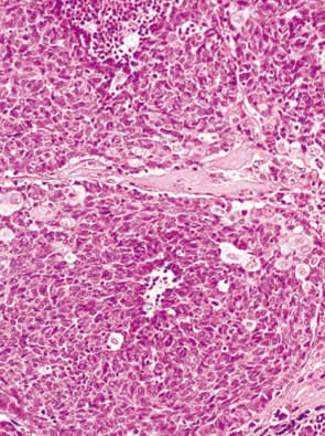 内分泌細胞癌（endocrine cell carcinoma）