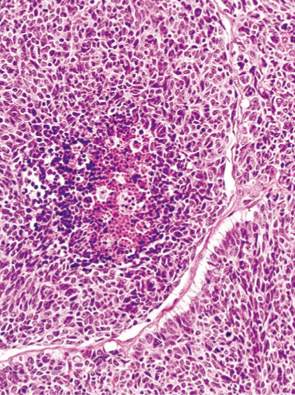 内分泌細胞癌（endocrine cell carcinoma）