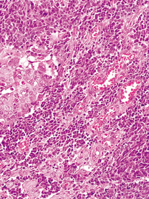 内分泌細胞癌（endocrine cell carcinoma）